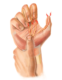 Wrist Injury Treatment