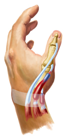 De Quervains Tenosynovitis